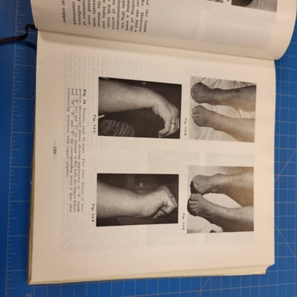 Causation Rheumatoid Disease Human Cancers Roger Wyburn-Mason Medicine Book - Picture 6 of 6